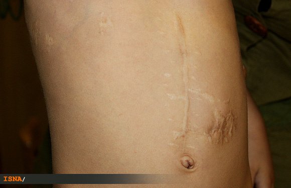 روژان کوچولو برای آینده بدون درد چشم انتظار کمک‌های مردمی 